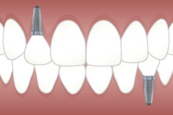 Implantes dentales económicos. Salud bucal sin gastar de más