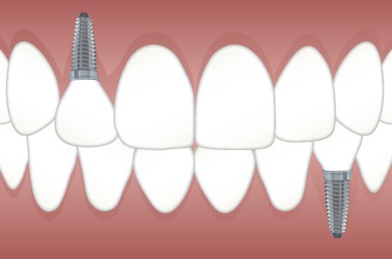 Implantes dentales económicos. Salud bucal sin gastar de más
