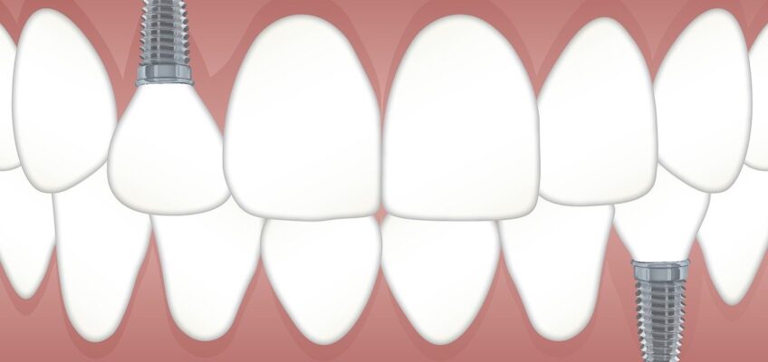 Implantes dentales económicos. Salud bucal sin gastar de más